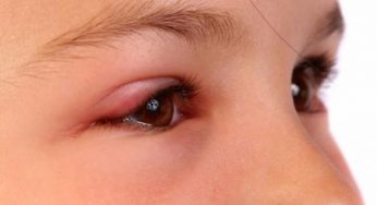 5 rimedi naturali contro l'orzaiolo