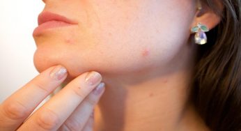 Acne: le principali cause e come intervenire