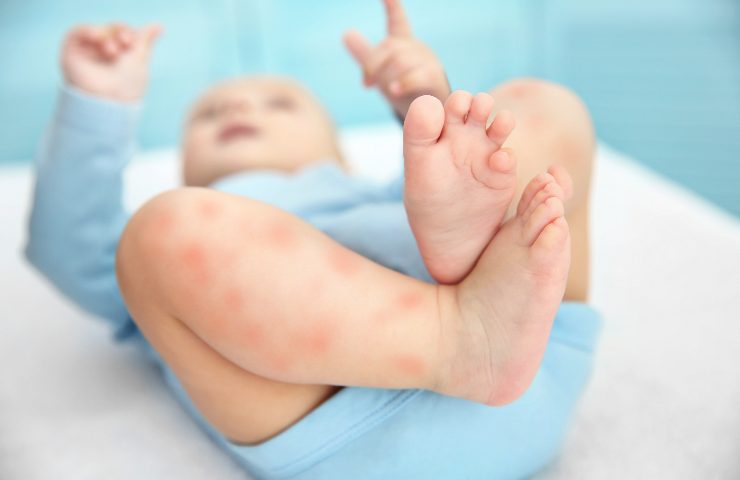 rimedio protezione neonato zanzare bolle pizzichi