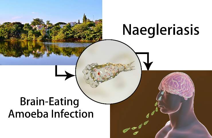 Naegleria fowleria contagio naso acqua 