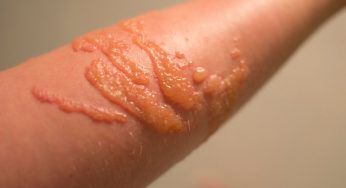 Puntura di medusa: cosa fare immediatamente!