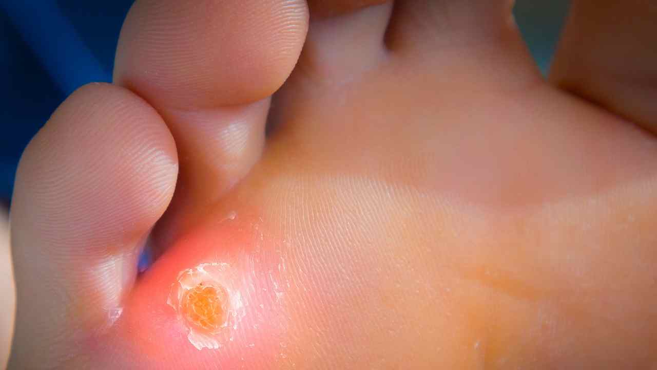Calli piedi prevenzione ingredienti