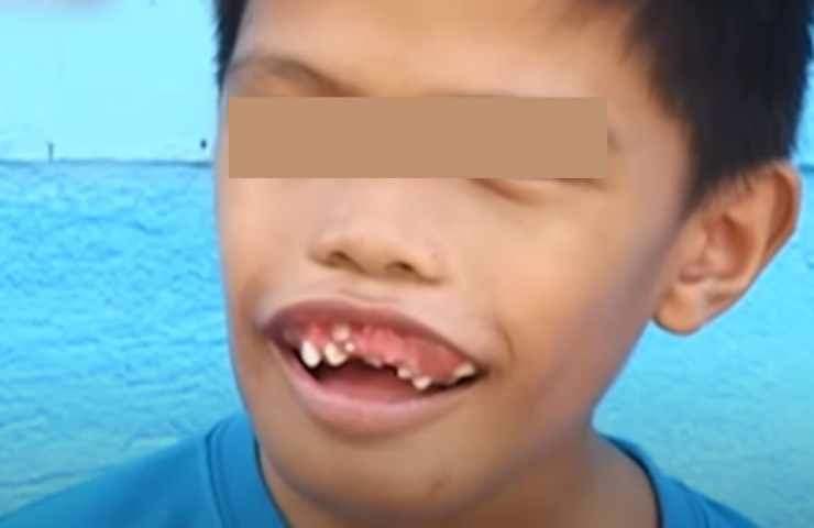 La condizione rara di un bambino: riguarda la sua bocca 