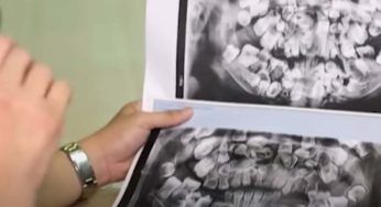 La bocca del bimbo nasconde una condizione rara: sarà strano vederla
